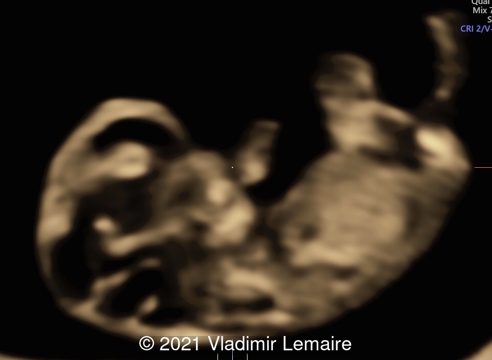 Demonstration of early brain development using Volume Contrast Imaging (VCI) with 1-2 mm thickness. Note the development of the fourth ventricle at this gestational age. The choroid plexus of the fourth ventricle is also visible.