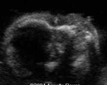 Townes-Brocks syndrome image