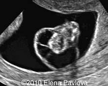 Monosomy X at 12 weeks of gestation image