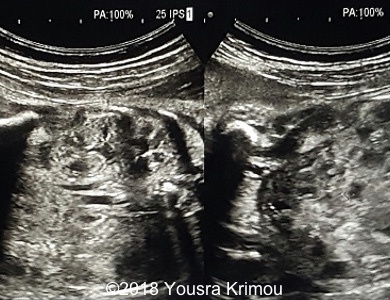 Ultrasound image showing a pelvic kidney and its vascularization 2