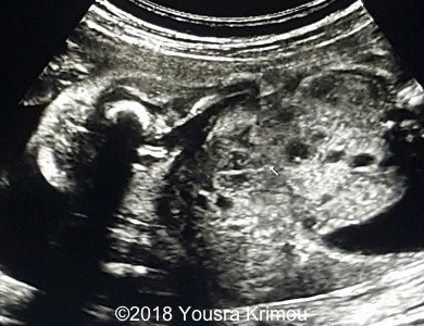 Ultrasound image showing a pelvic kidney and its vascularization 3