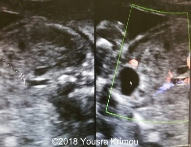 Ultrasound image showing a pelvic kidney and its vascularization 4