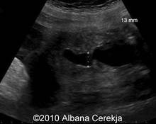 Umbilical vein varix, Intra-abdominal image
