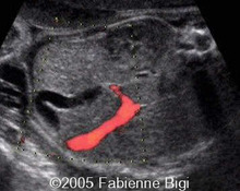 Gallbladder fold image