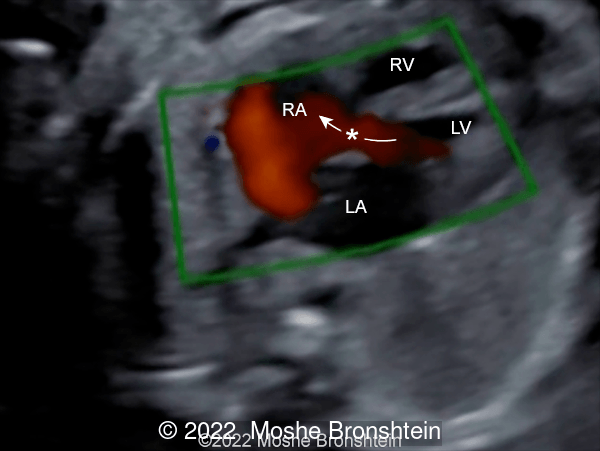 Isolated Gerbode defect (marked with the arrow) at 25 weeks gestation